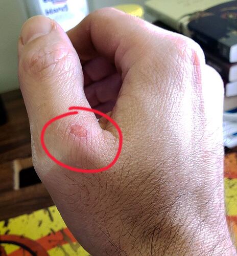 hand inury
